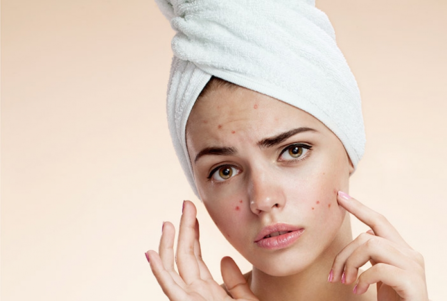 Prompt treatment of acne